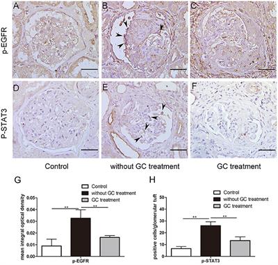 Glucocorticoids Inhibit EGFR Signaling Activation in Podocytes in Anti-GBM Crescentic Glomerulonephritis